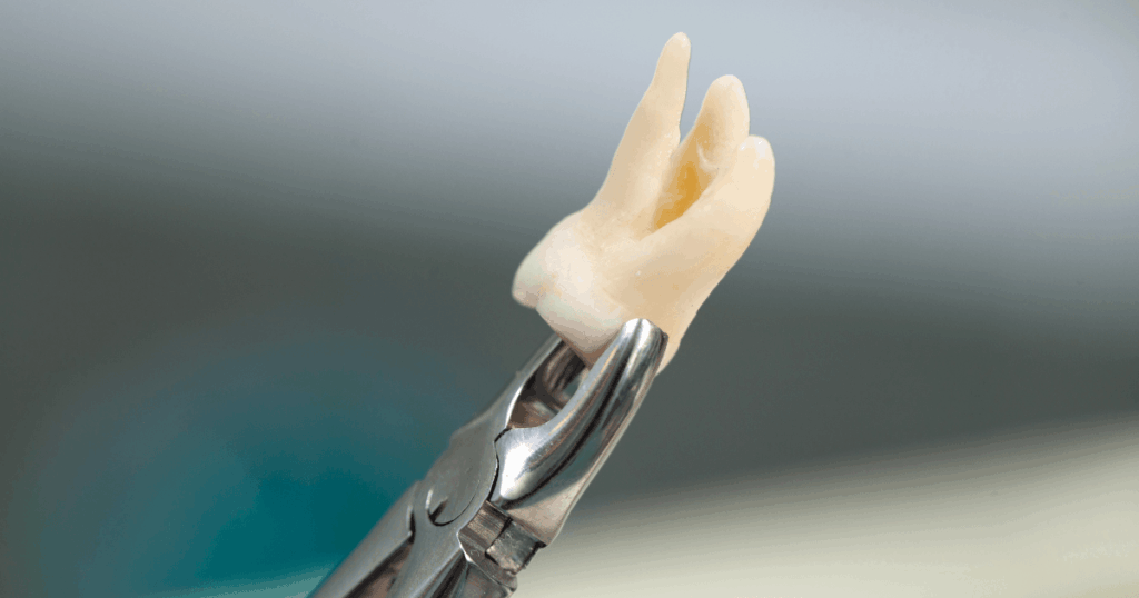 親知らず抜歯後に腫れる原因や腫れやすいケースを説明するイメージ