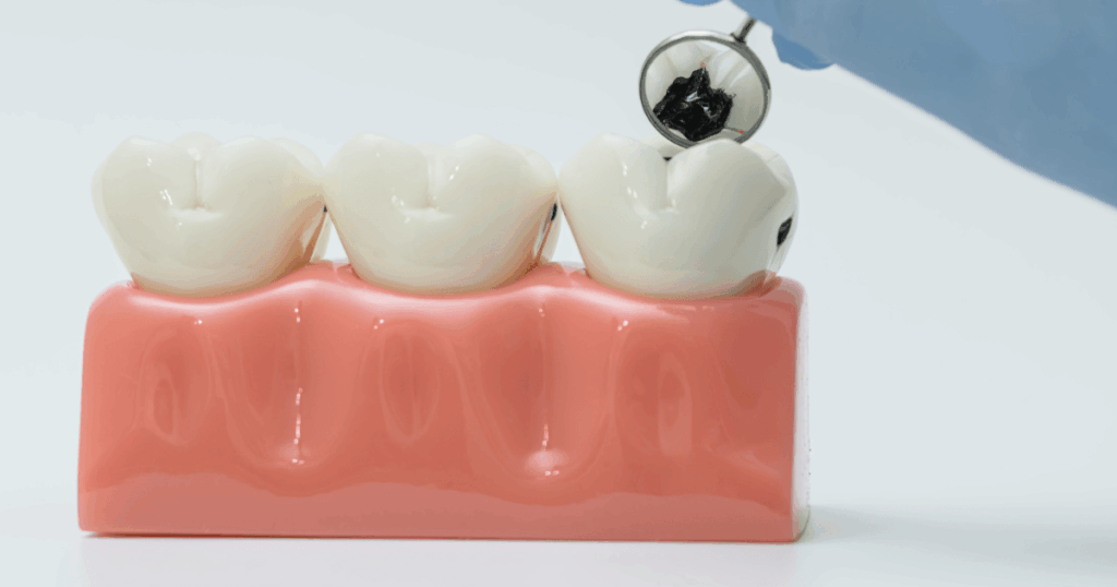 親知らずが虫歯