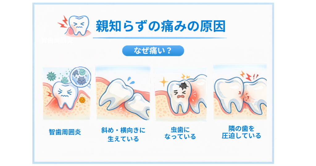 親知らずの痛みの原因を説明する図