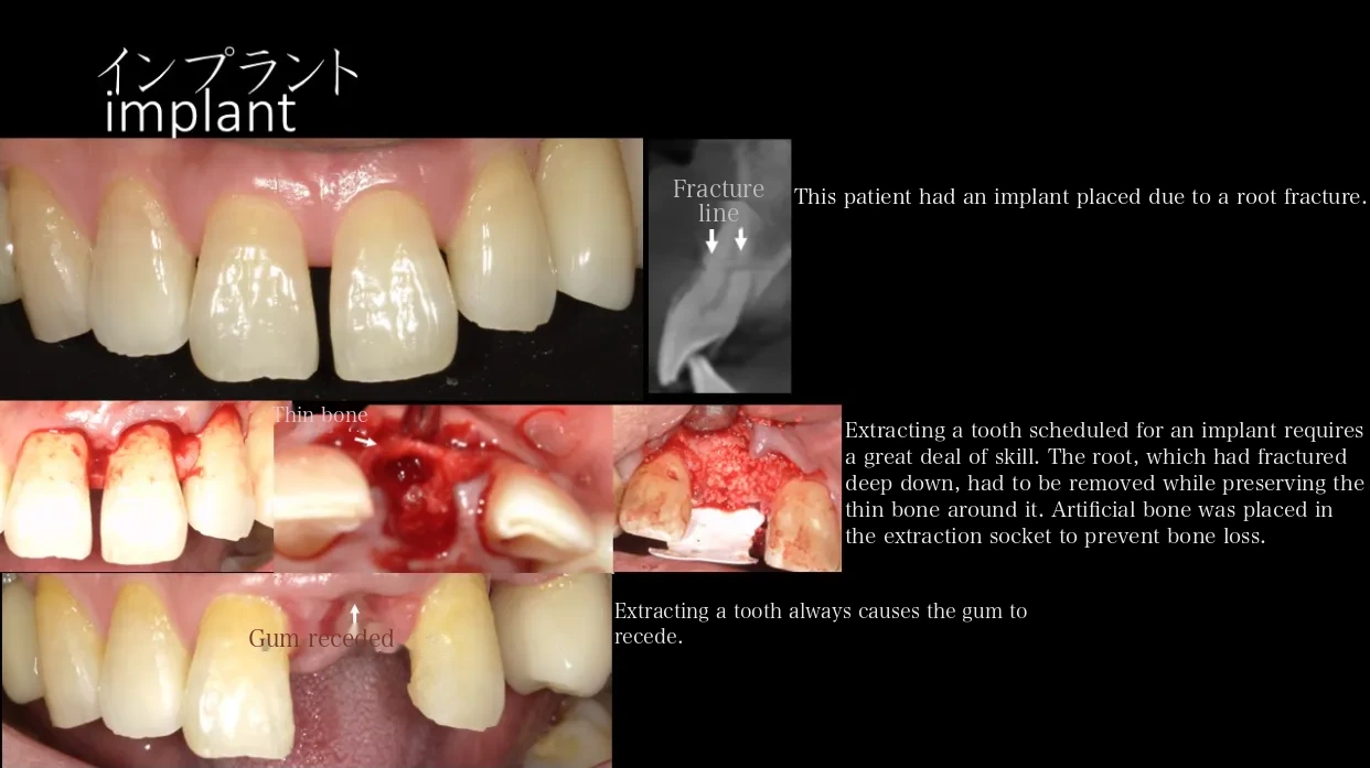 Dental implant treatment case examples