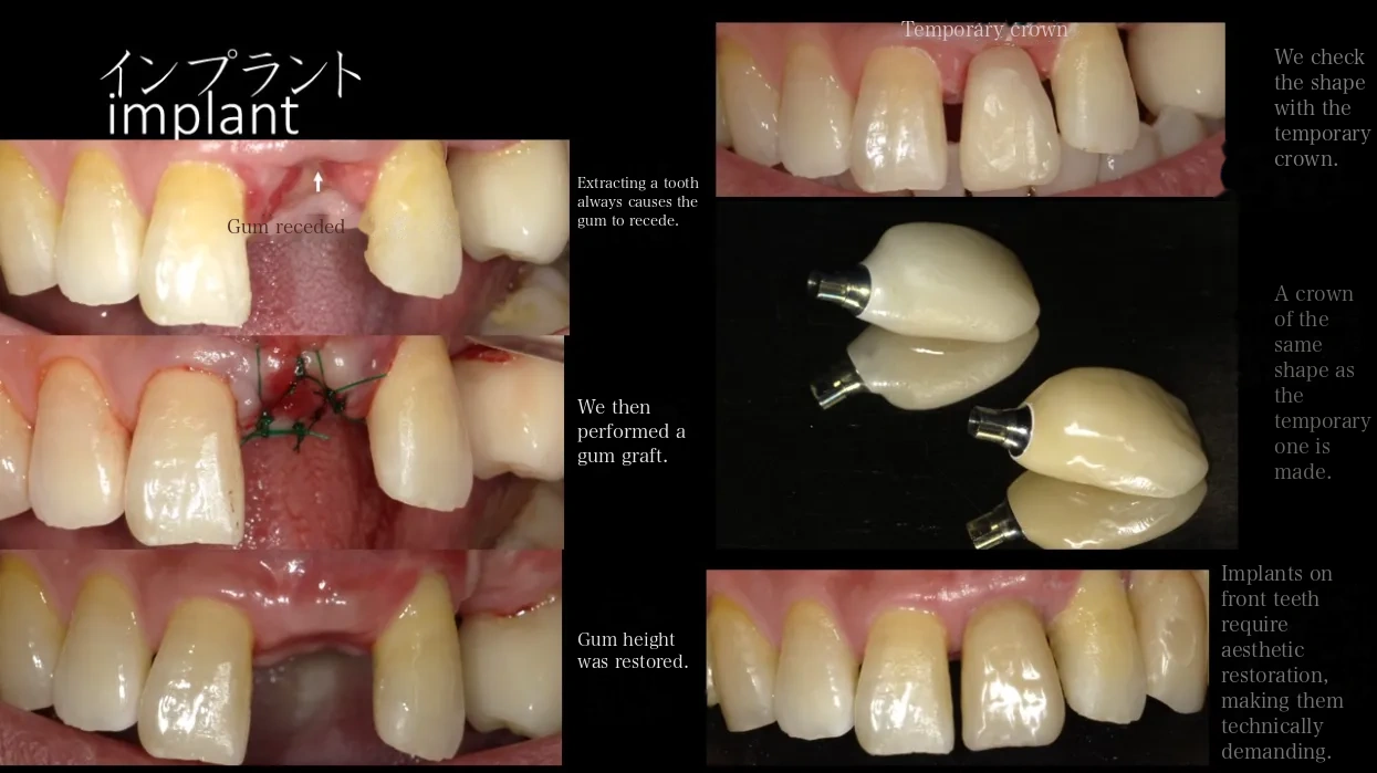 Dental implant treatment case examples