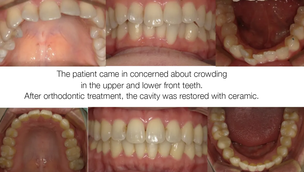 Clear aligner treatment case study