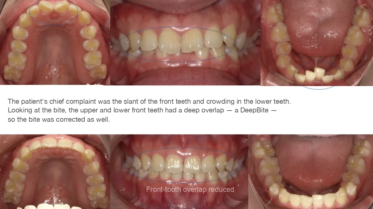 Clear aligner treatment case study