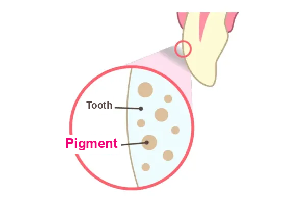 A discolored tooth