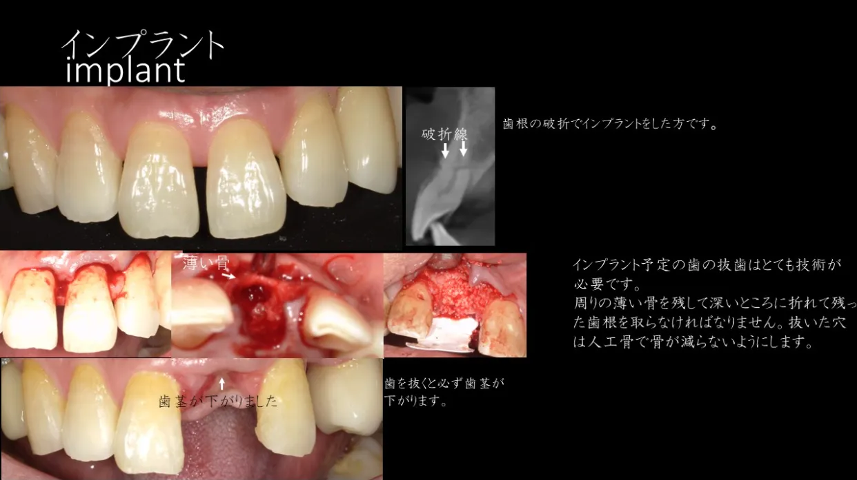 インプラント治療の事例紹介