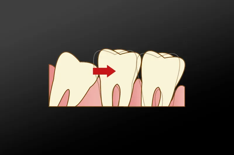 親知らずが生えてくるスペースが確保されておらず正常な歯並びを乱してしまうと判断した場合