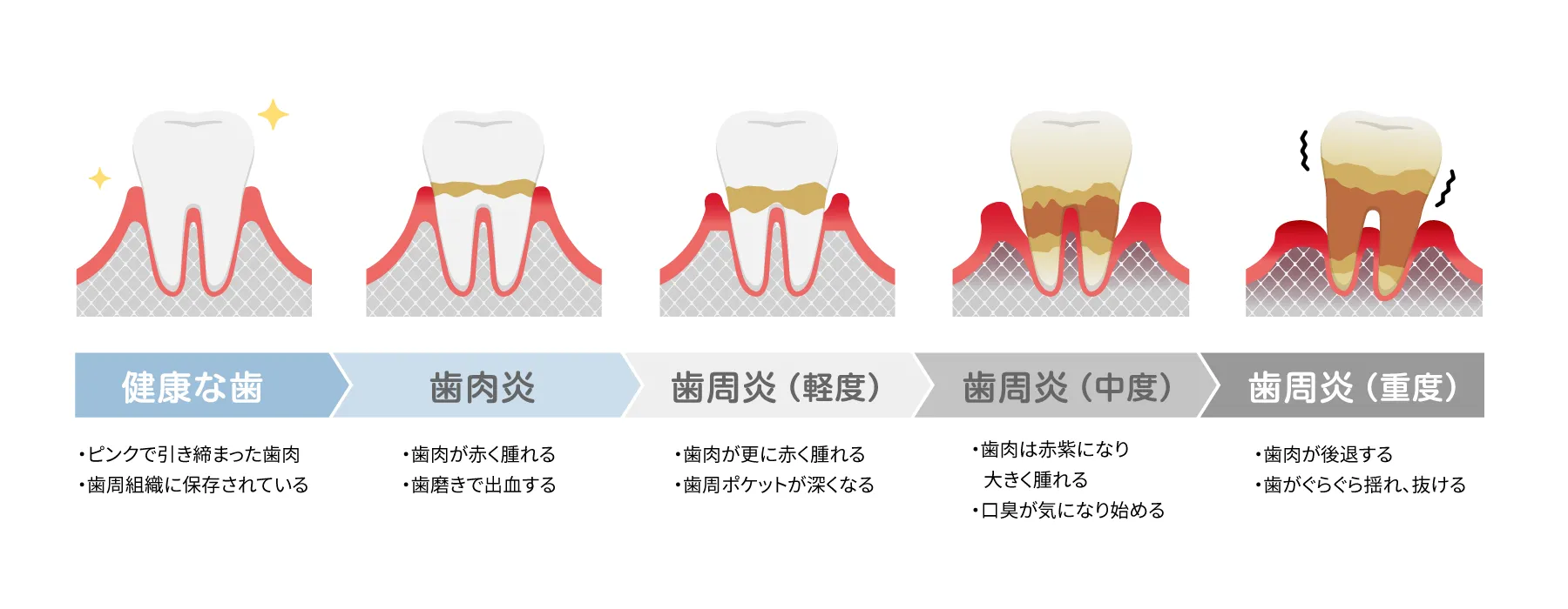 歯周病は治らない？