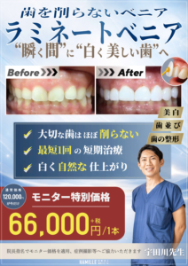 【4月スタート】歯を削らない「ラミネートベニア」特別モニター募集のお知らせ